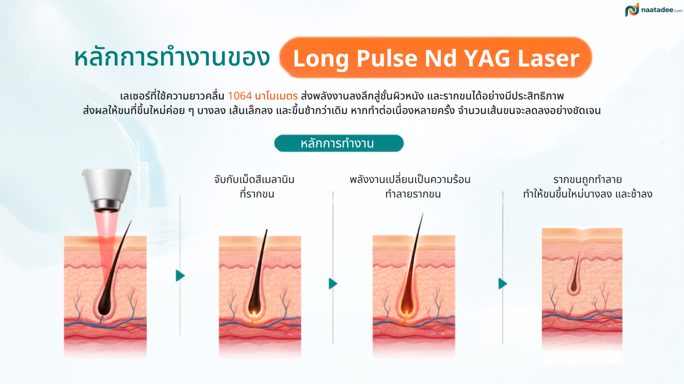 หลักการทำงานของ Long Pulse Nd YAG Laser